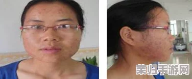 揉豆豆:绝对有效的祛痘方法,让你告别烦恼! 揉豆豆:绝对有效的祛痘方法,让你告别烦恼!